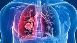 القومي للأورام: علاجات حديثة لسرطان...